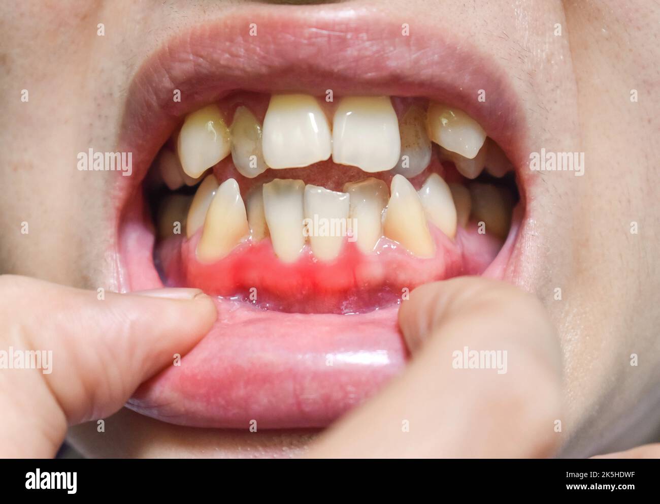 Entzündung des Zahnfleisches, genannt Gingivitis. Parodontalproblem. Schlechte Mundhygiene. Stockfoto