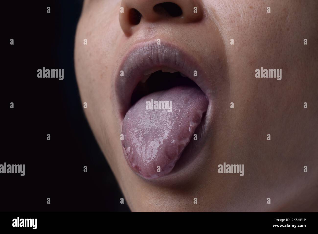 Zentrale Zyanose bei einem jungen Mann aus Südostasien mit angeborenem Herzfehler. Stockfoto