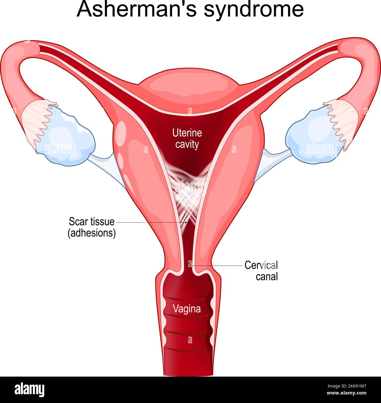 Asherman-Syndrom. Querschnitt der Gebärmutter mit Verklebungen. Narbengewebe in der Gebärmutterhöhle. Intrauterine Synechien. Probleme der Unfruchtbarkeit. Stock Vektor