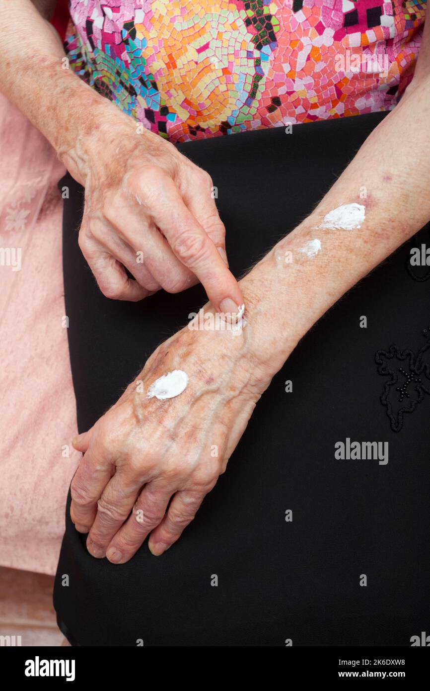Ältere Frau kümmert sich um die Haut an ihren Armen und Händen mit Creme, Hautunreinheiten, Alter Stockfoto