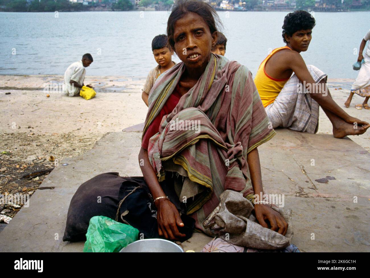 Kolkata (Kalkutta) Indien Nimtola Ghat Frau Mit Elephantiasis Stockfoto