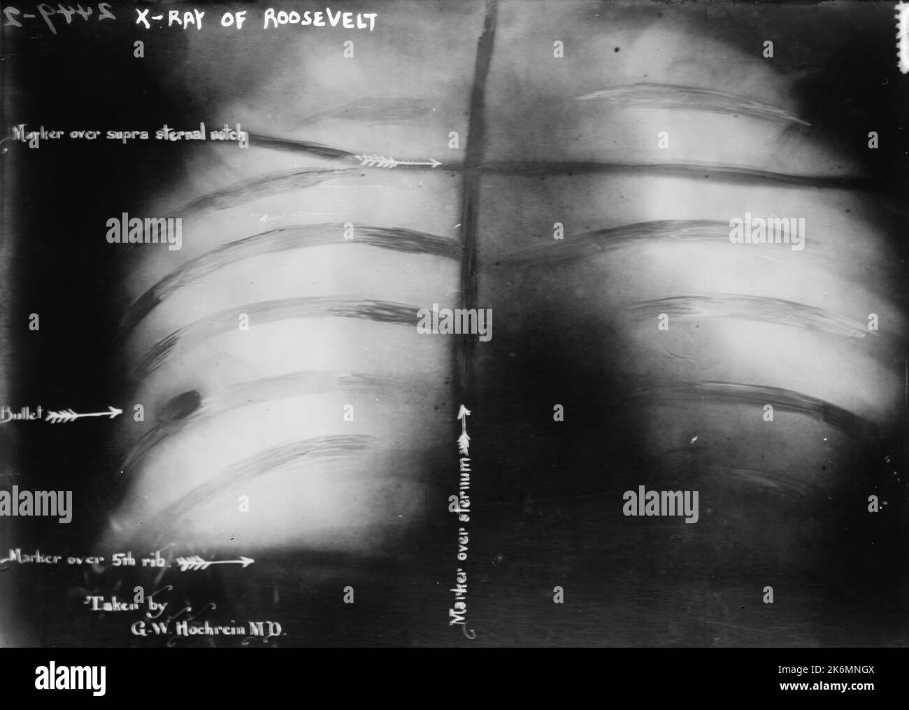 Theodore Roosevelts medizinische Röntgenaufnahme am 14. Oktober 1912, nach dem Attentat, zeigt die Kugel, die lebenslang in seinem Körper bleiben würde Stockfoto