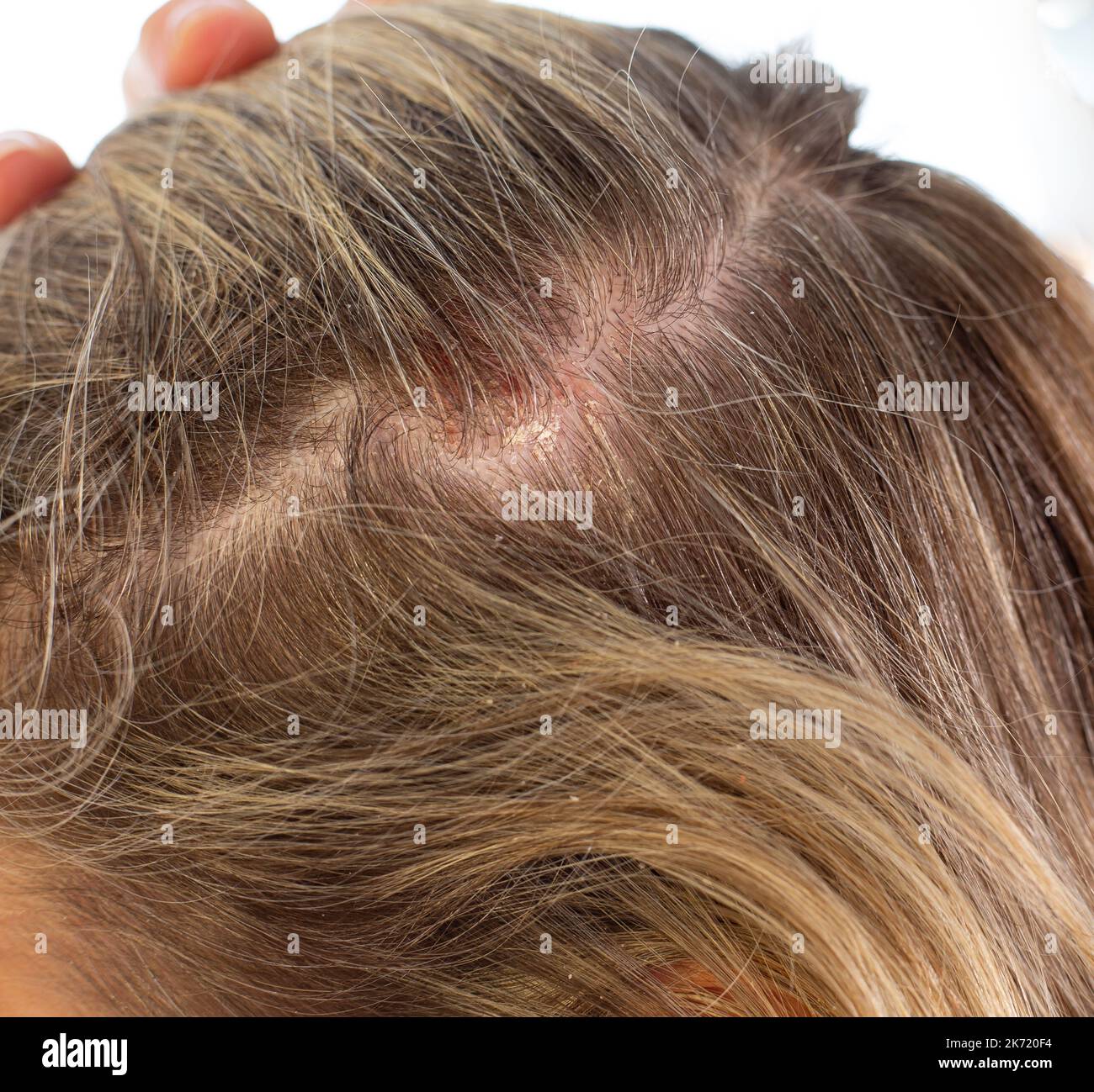 Psoriasis der Kopfhaut, psoriatische Rötung, Peeling und Krusten auf der Kopfhaut einer