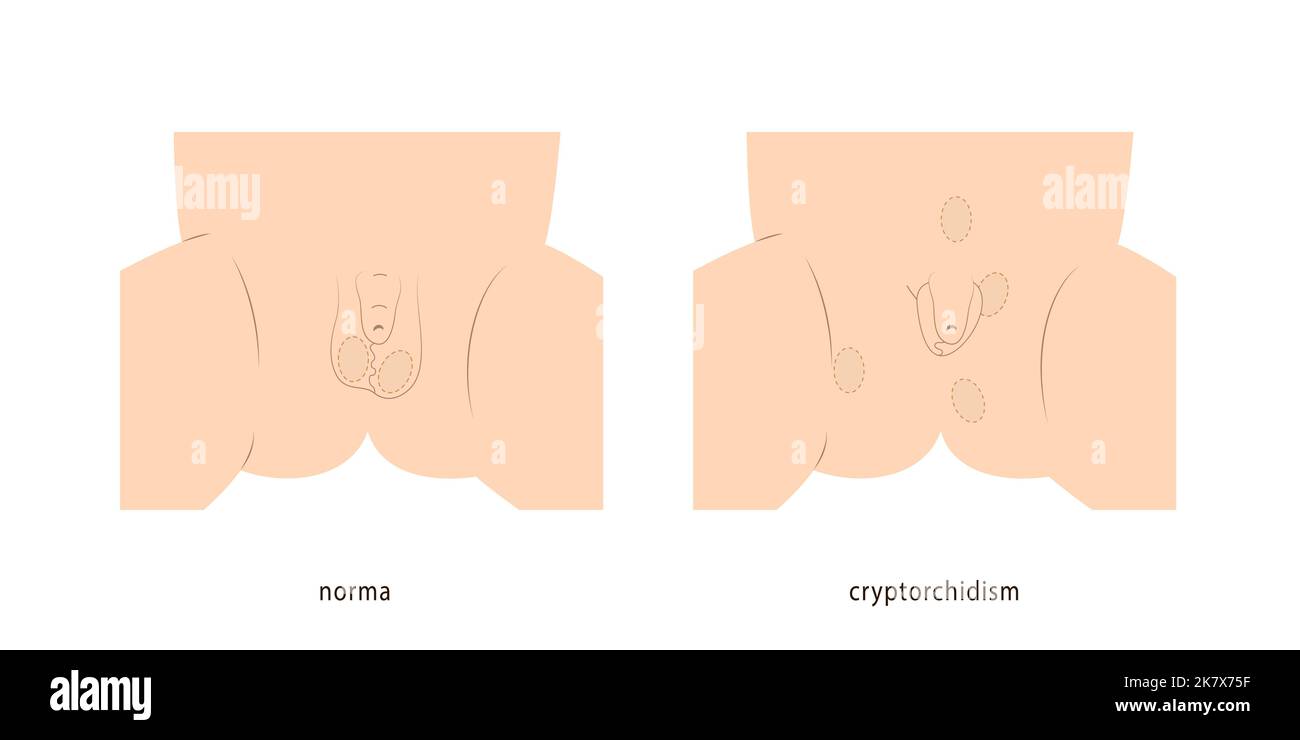 Medizinische Illustration des kleinen Jungen Hodensack gesund und mit nicht abstammenden Hoden zeigt mögliche Lage der Hoden. Stock Vektor