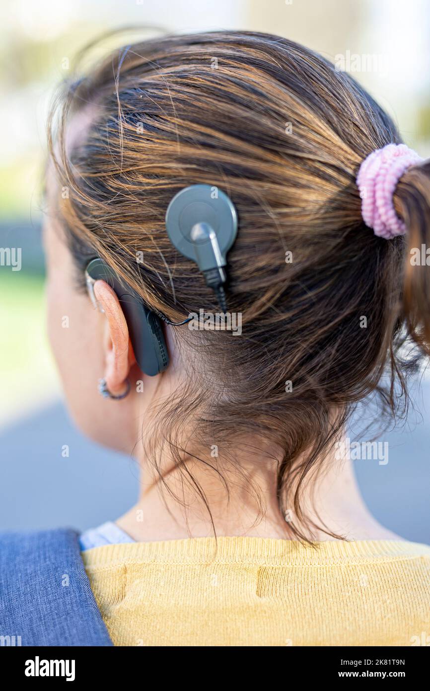 Frauenkopf mit Cochleral-Implantat-Hörgerät Stockfoto