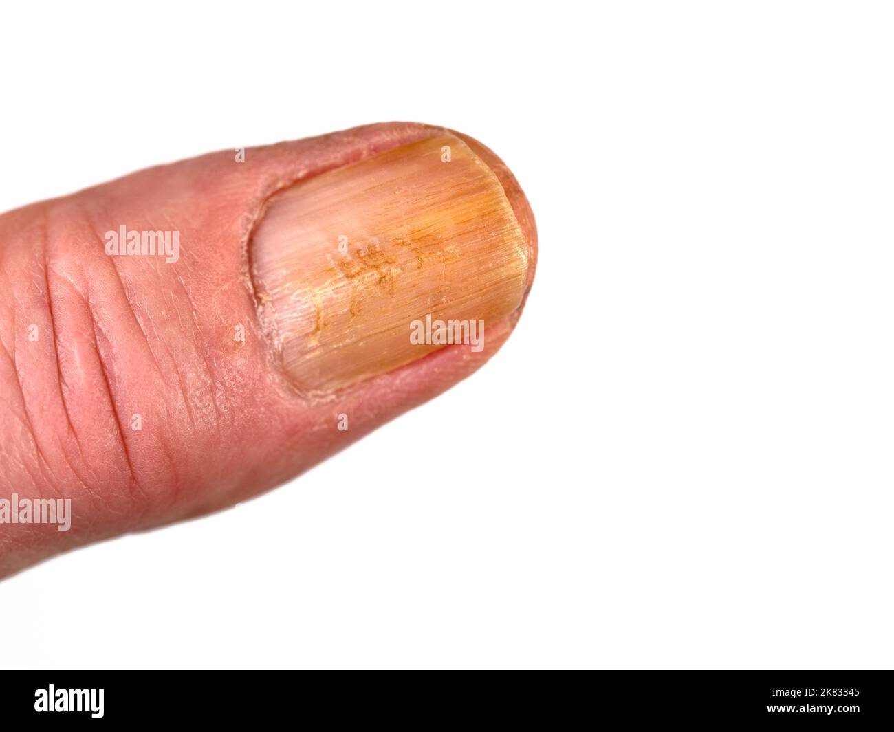 Fingernagel mit Nagelpilz vor weißem Hintergrund Stockfoto