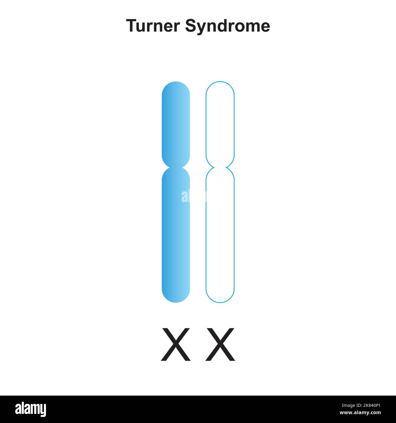 Wissenschaftliche Entwicklung des Turner-Syndroms (Monosomie X). Bunte Symbole. Vektorgrafik. Stock Vektor