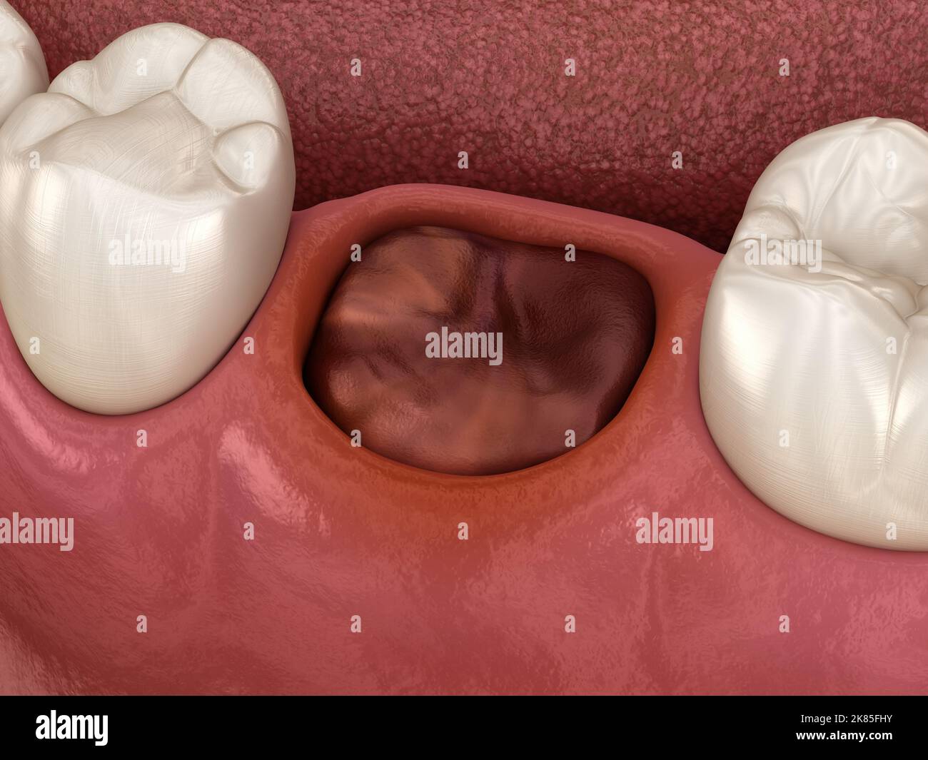 Das Blutgerinnsel verschließt den Zahn nach der Extraktion. Medizinisch genaue 3D-Darstellung Stockfoto