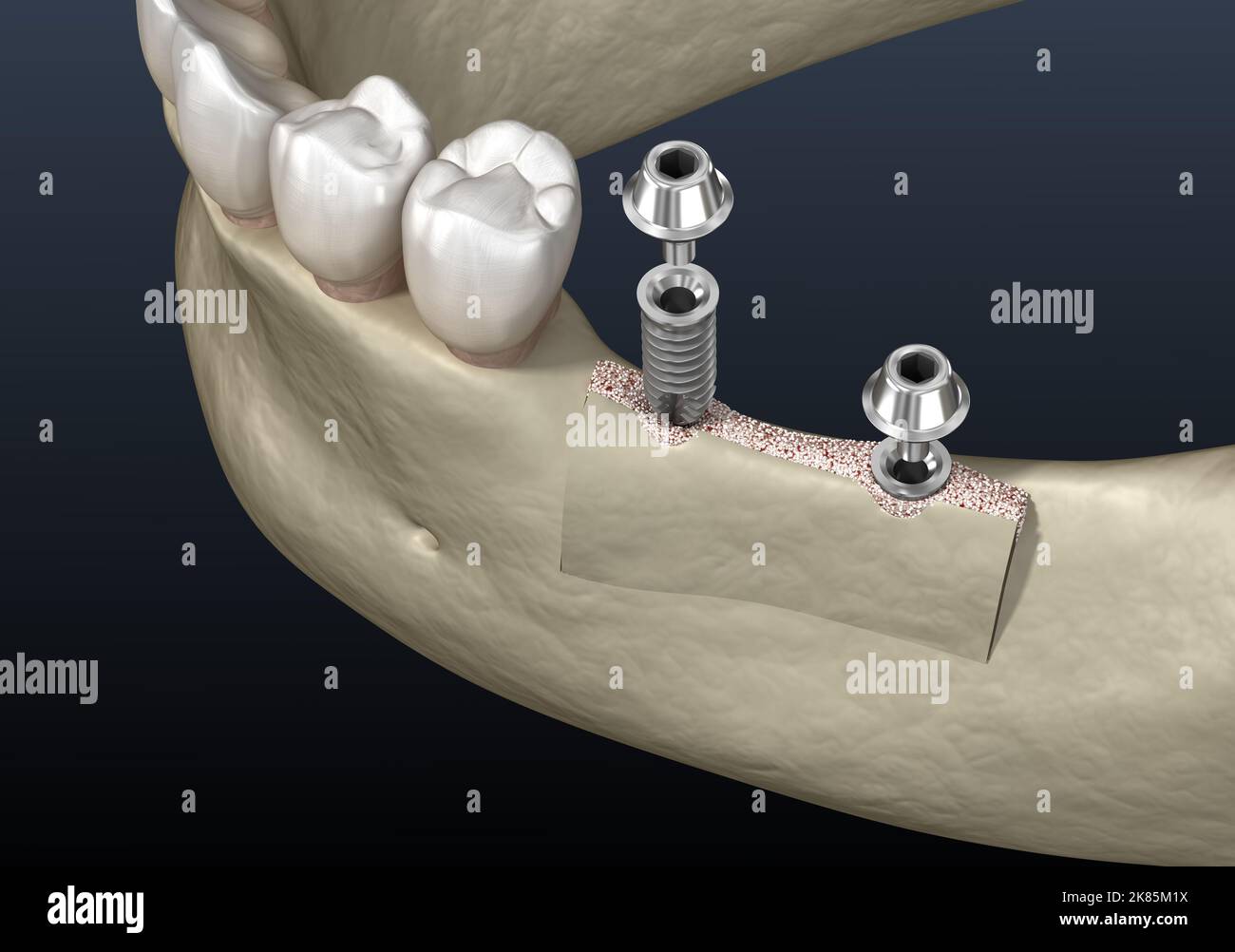 Spaltung des Alveolarkamms : Implantation. Zahnchirurgie, 3D Abbildung Stockfoto