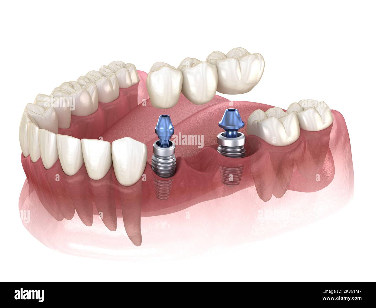 Brücke von Implantaten. Medizinisch genaue 3D-Abbildung der menschlichen Zähne und Zahnersatz Konzept Stockfoto
