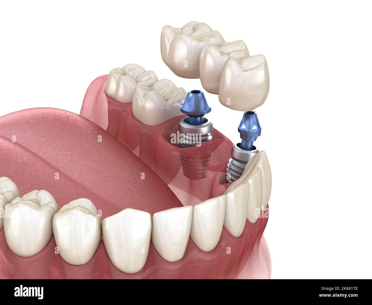 Brücke von Implantaten. Medizinisch genaue 3D-Abbildung der menschlichen Zähne und Zahnersatz Konzept Stockfoto