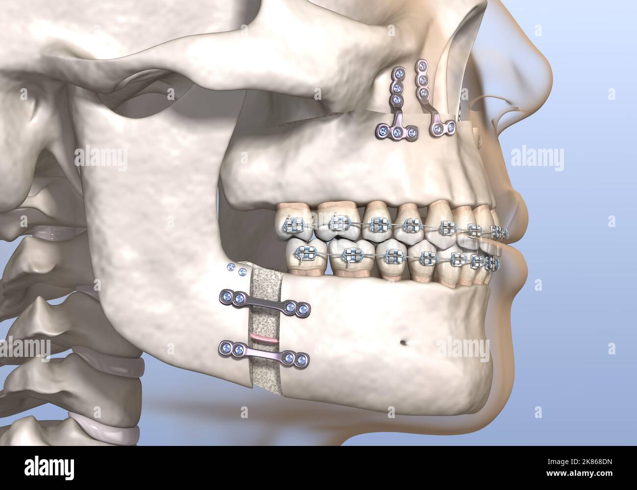 Maxillomandibuläre Advancement Chirurgie. Medizinisch genaue zahnärztliche 3D Illustration. Stockfoto