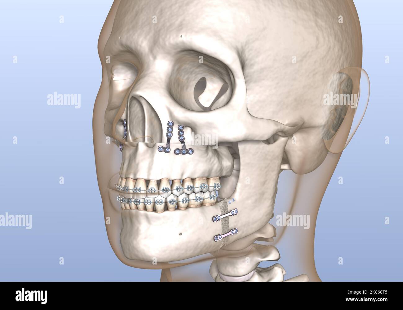 Maxillomandibuläre Advancement Chirurgie. Medizinisch genaue zahnärztliche 3D Illustration. Stockfoto