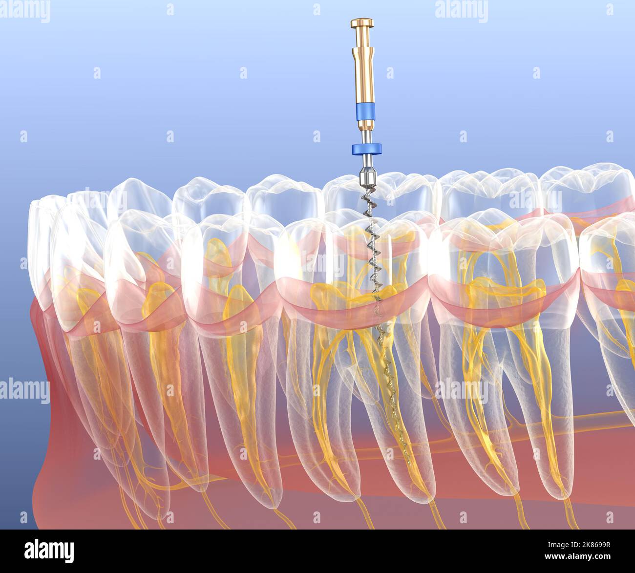 Endodontische Wurzelbehandlung. Medizinisch akkurate Zahn 3D Abbildung. Stockfoto