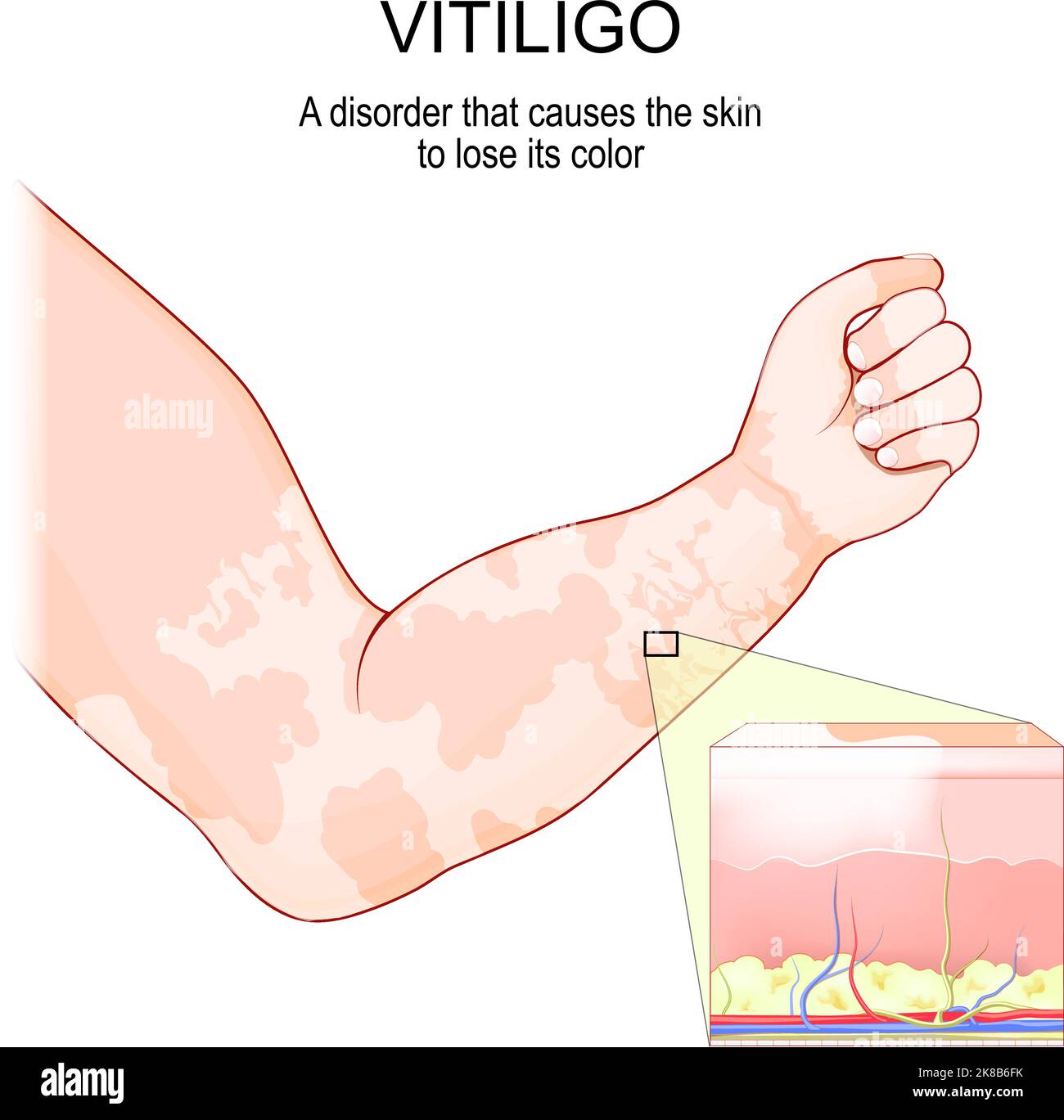 Vitiligo. Menschliche Hand mit Hauterkrankung. Querschnitt der Haut, die ihre Farbe verlieren. vektor-Illustration Stock Vektor