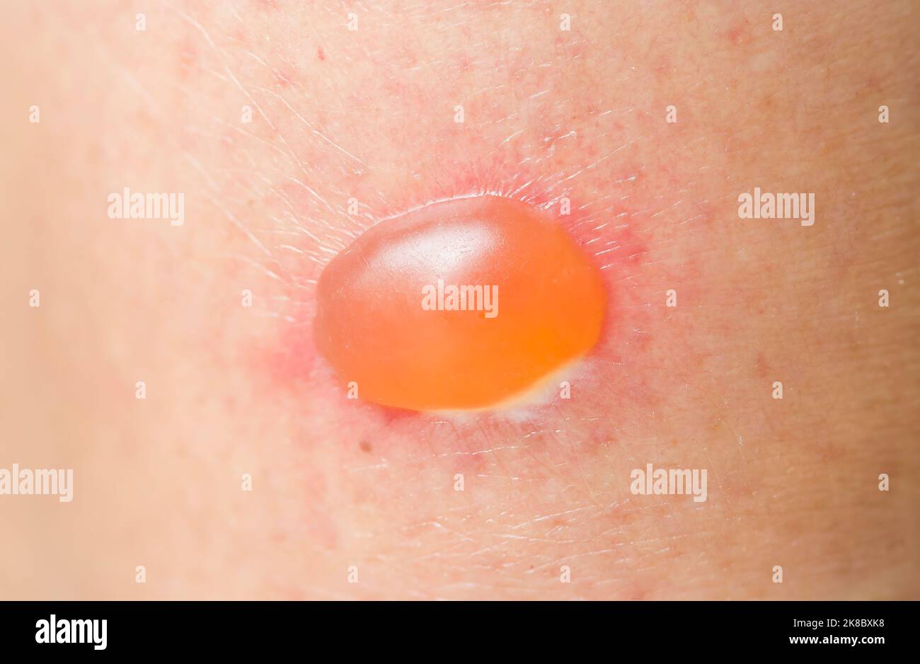 Dermatologie und Hautkrankheiten: Blister auf der Haut einer asiatischen Frau aufgrund einer Hautinfektion oder allergischen Reaktion Stockfoto