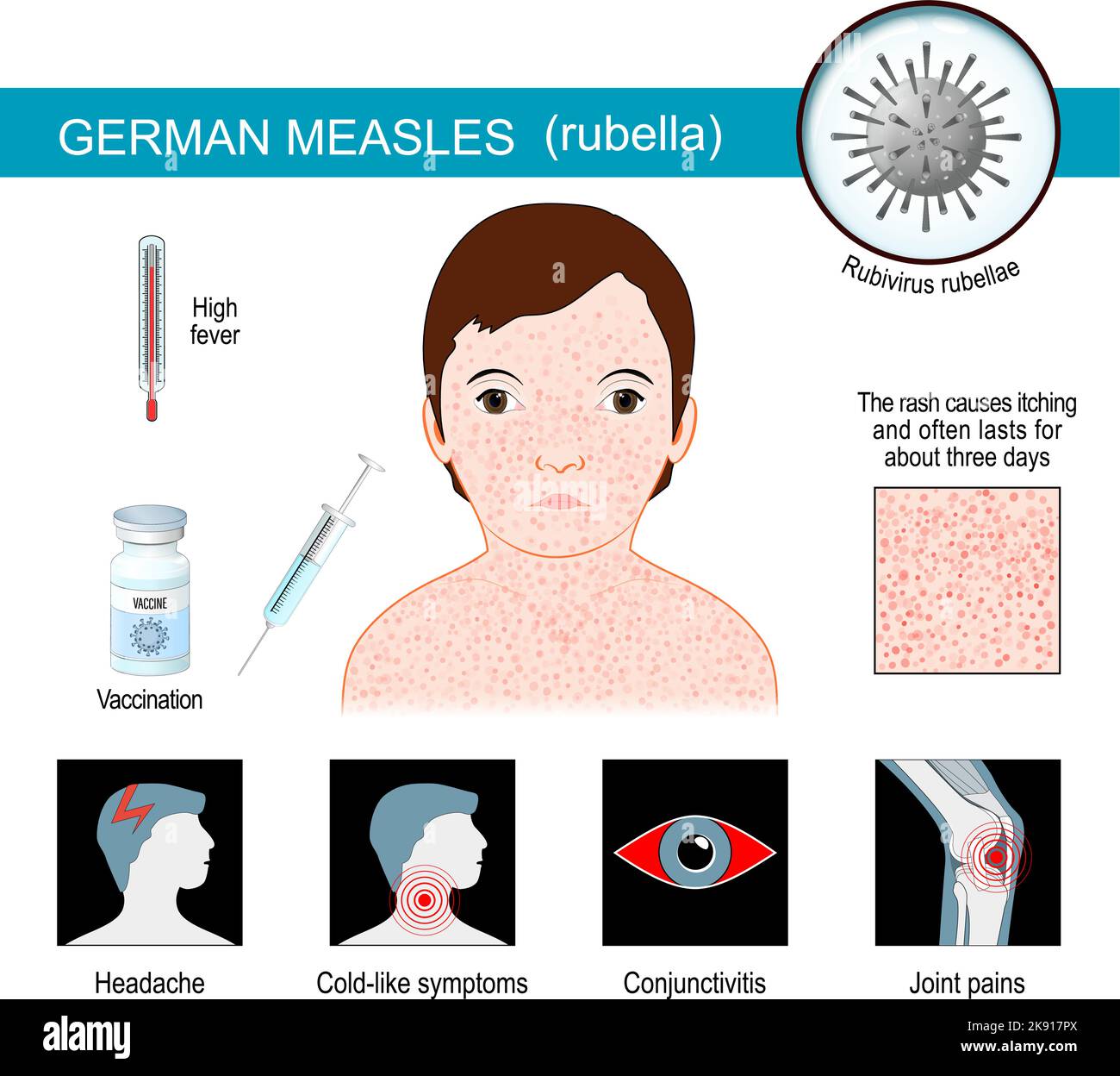 Masern in Deutschland. Infografiken zu Anzeichen und Symptomen von Röteln. Drei-Tage-Masern sind Krankheiten, die durch eine Infektion des Rötelnvirus verursacht werden. Vektor Stock Vektor