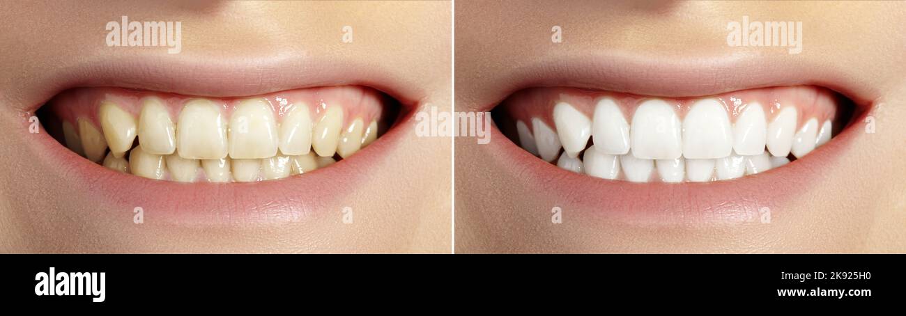 Frau Zähne vor und nach dem Aufhellen. Perfektes Lächeln mit gesunden Zähnen. Patient Der Zahnklinik. Zahnmedizin und Stomatologie Stockfoto