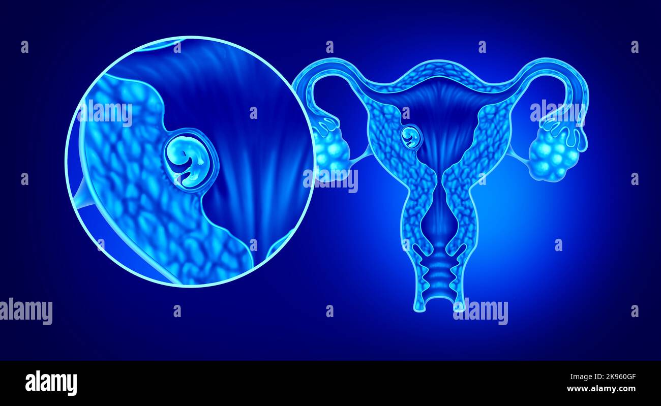 Implantiertes menschliches Embryonalkonzept und erfolgreiche Schwangerschaftsimplantation in der Gebärmutter als wachsender Fötus in einem weiblichen Körper Geburtshilfe und Gynäkologie Stockfoto