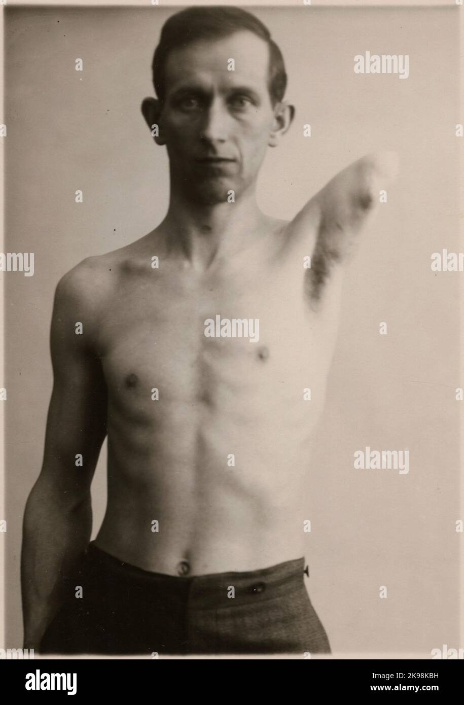 Fotografie aus „ein Bericht über die Herstellung in der Prothesenwerkstatt der Staatsbahn in Nässjö“, 1932. Mann mit ampuiertem Arm, um eine Prothese von der Prothesenwerkstatt in Nässjö herstellen zu lassen. Stockfoto