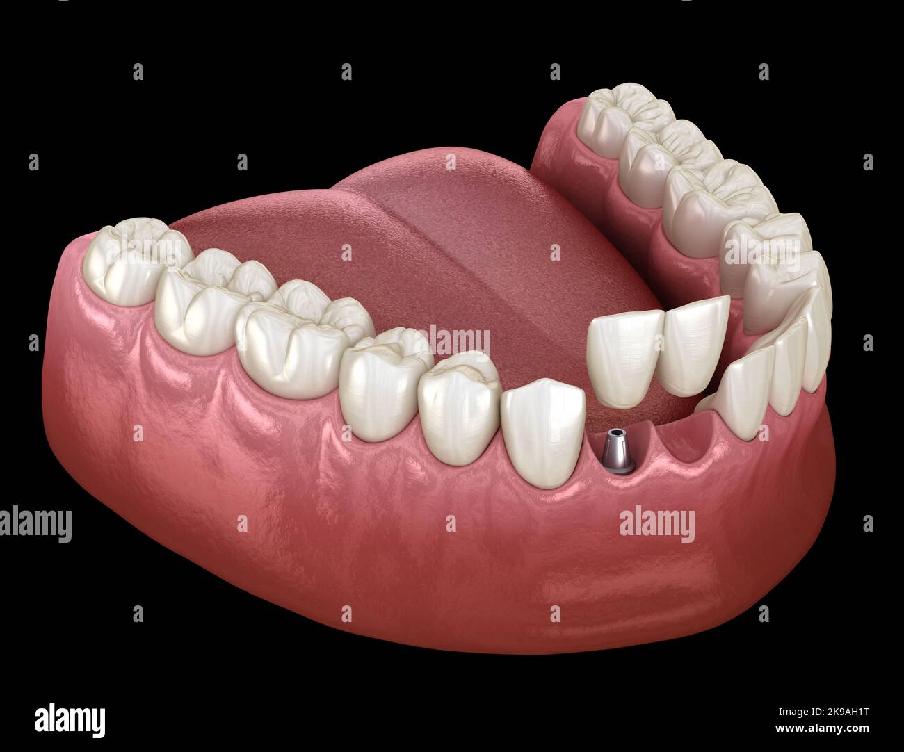 Cantilever Bridge Implantat basiert, frontale Zahnwiederherstellung. Medizinisch akkurate 3D Animation des Zahnkonzepts Stockfoto