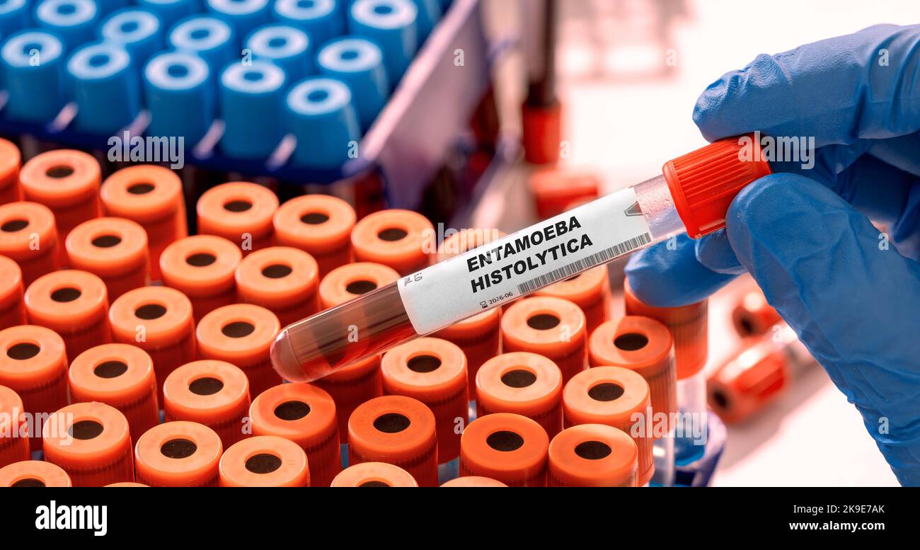 Entamoeba histolytica Antibody-Reagenzglas mit Blutprobe im Infektionslabor Stockfoto