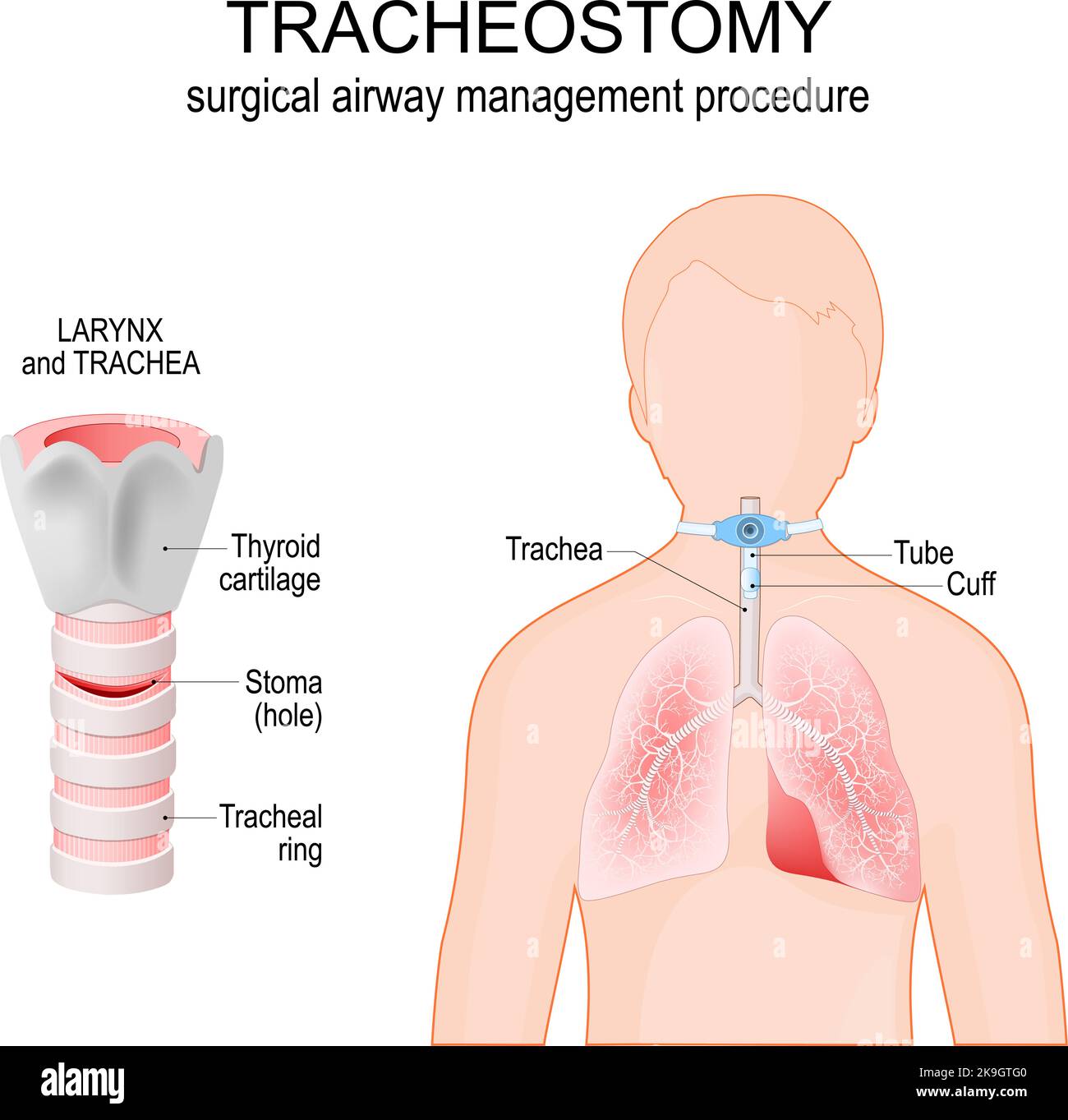 Tracheostomie. Chirurgisches Atemwegsmanagement. Anatomie der Trachea mit Stoma. Kehlkopf. Menschliche Silhouette mit Lunge, Trachea, Bronchien Stock Vektor