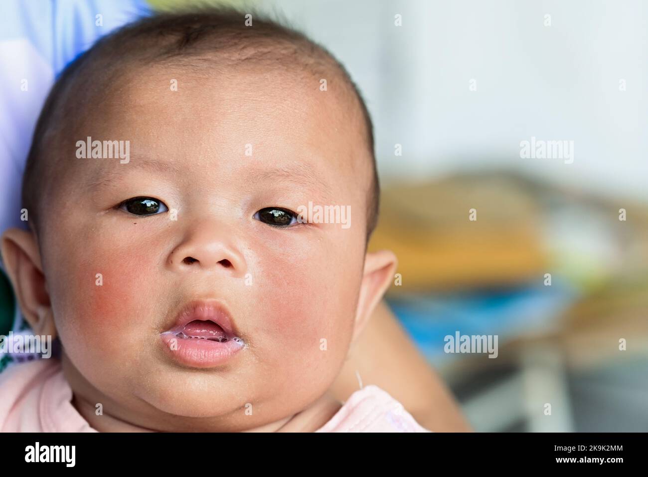 Hautausschlag auf dem Gesicht des Babys, Baby mit Dermatitis Problem des Hautausschlags. Allergie, die an Lebensmittelallergien leidet. Nahaufnahme atopisches Symptom auf den Hautbacken. Konzept Stockfoto