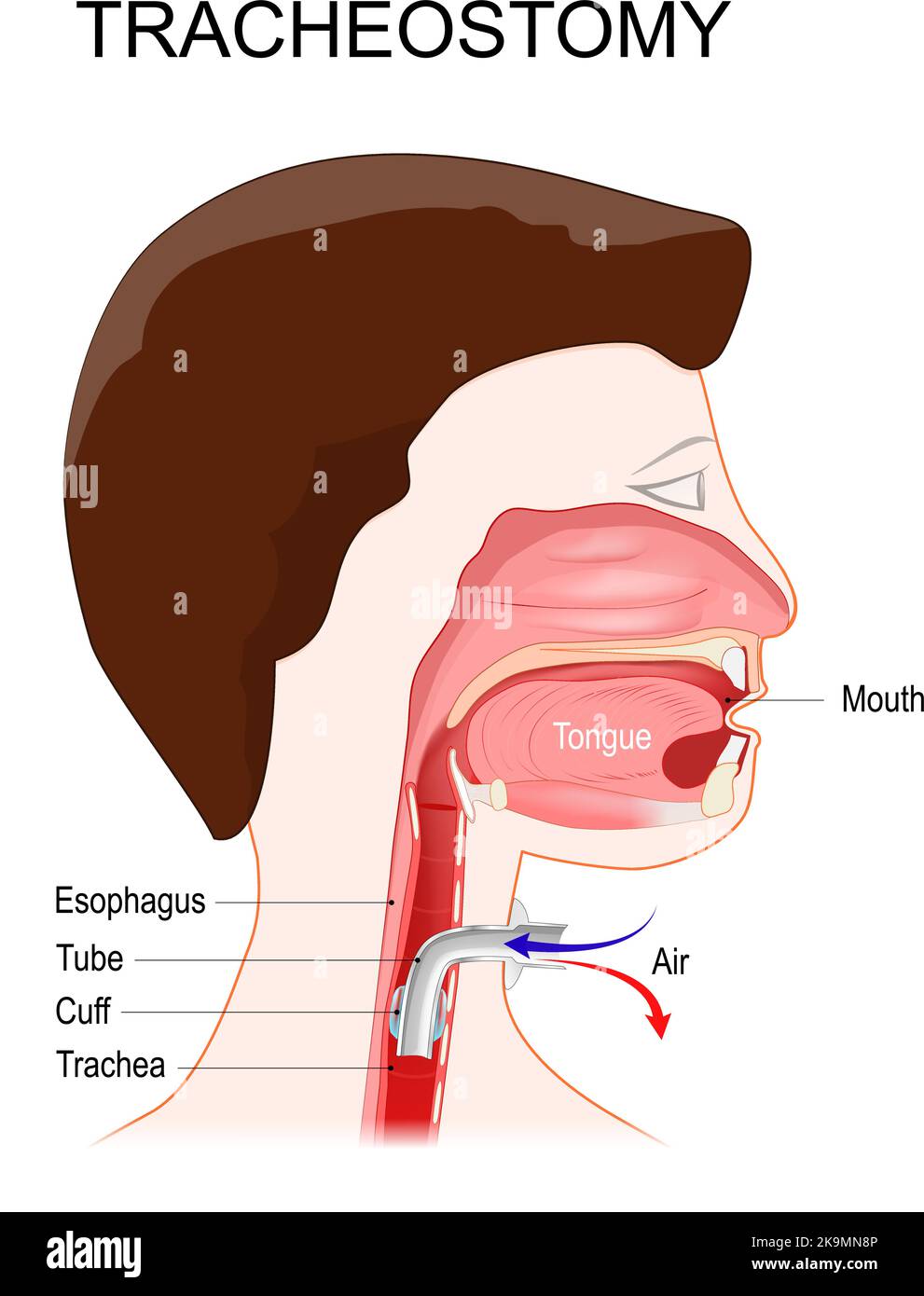 Tracheotomie. Seitenansicht des Halses und korrekte Platzierung eines Tracheostomieschlauchs in der Trachea. Das Stoma für einen Trachealtubus oder Tracheostomietubus Stock Vektor