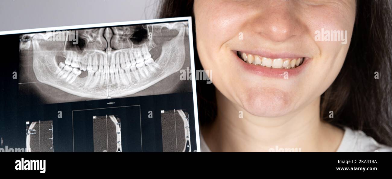 Ein Patient mit einer Fehlfunktion, fehlendem Kauzahn und einer Funktionsstörung des Kiefergelenks hält seinen CT-Scan des Kiefers fest Stockfoto