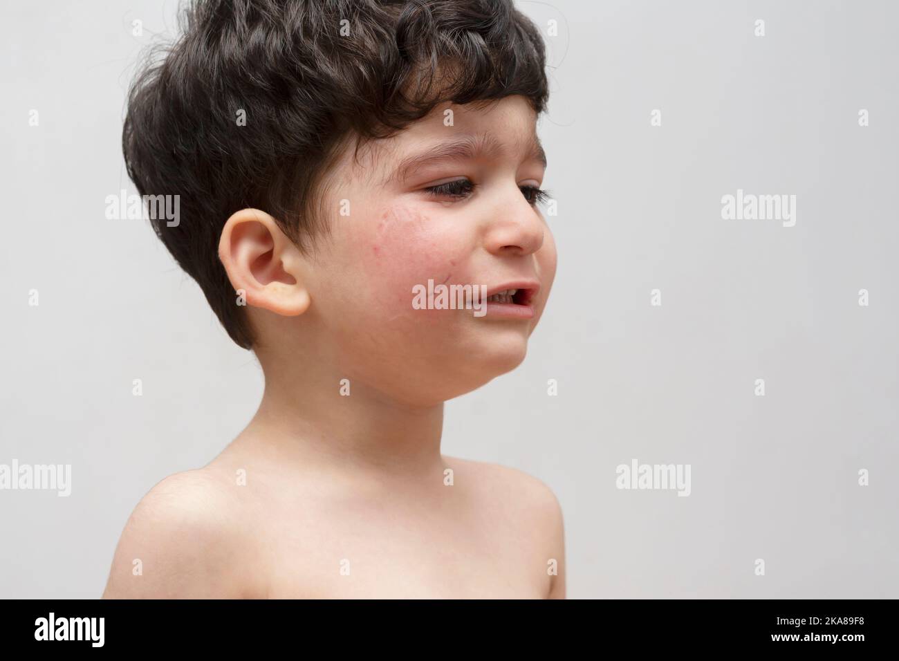 Porträt eines weinenden Jungen, der von einem anderen Kind in die Wange gebissen wurde Stockfoto