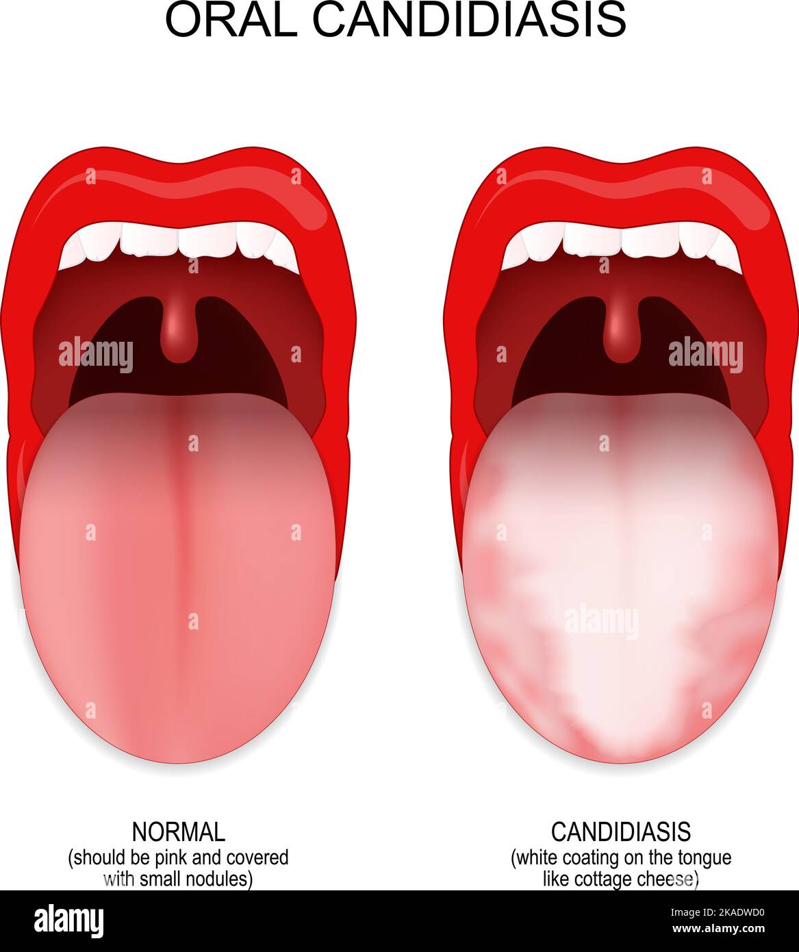 Orale Candidiasis. Unterschied und Vergleich von gesunden Mund und Zunge mit Pilzinfektion. vektor-Poster Stock Vektor