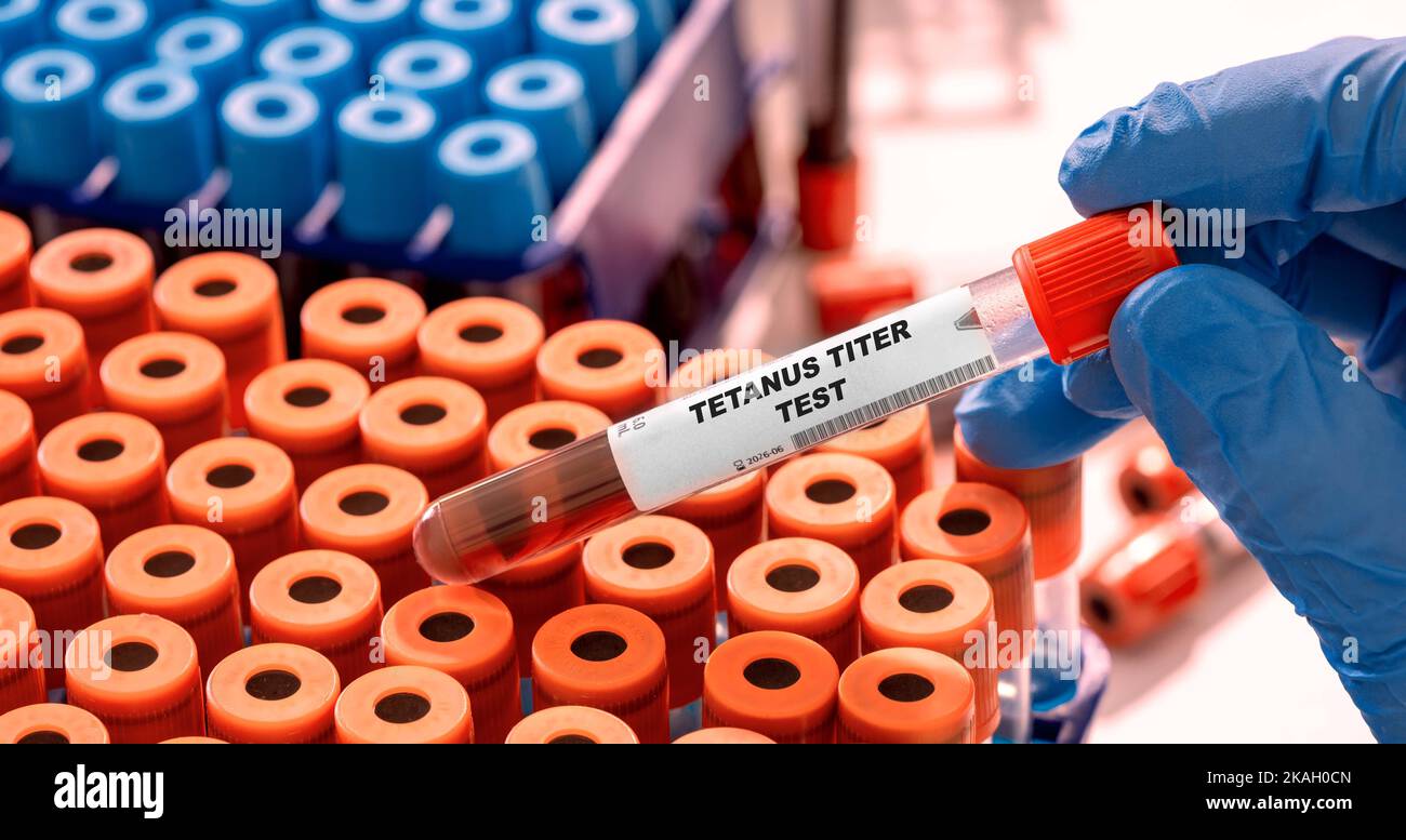 Tetanus Titer Reagenzglas mit Blutprobe im Infektionslabor Stockfoto