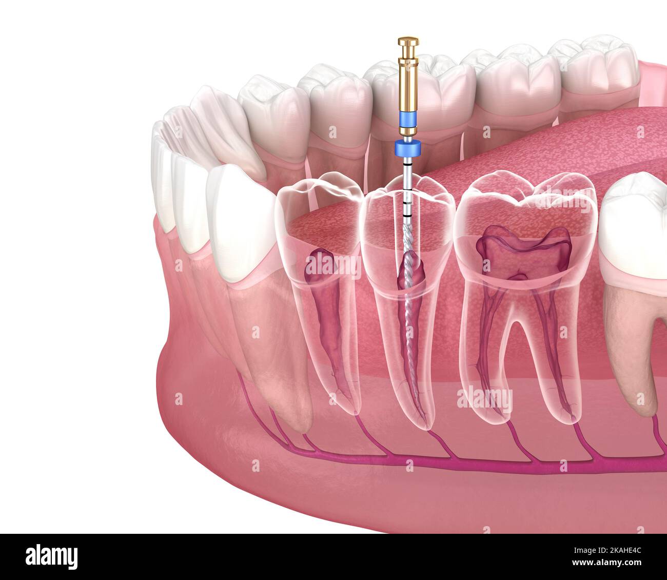 Endodontische Wurzelbehandlung. Medizinisch akkurate Zahn 3D Abbildung. Stockfoto