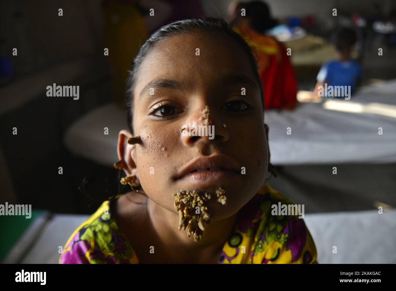 Auf diesem Foto, das am 30. Januar 2017 aufgenommen wurde, posiert der 10-Jahre-Patient aus Bangladesch, Sahana Khatun, für ein Foto am Dhaka Medical College and Hospital. Ein junges Mädchen aus Bangladesch mit rindenähnlichen Warzen, die auf ihrem Gesicht wachsen, könnte die erste Frau sein, die jemals von einem so genannten „Baum-Mann-Syndrom“ betroffen war, sagten Ärzte, die die seltene Erkrankung studierten, im Januar 31. Die zehnjährige Sahana Khatun hat die erzählenden knarrigen Wucherungen, die aus ihrem Kinn, Ohr und ihrer Nase sprießen, aber die Ärzte im Krankenhaus der Medizinischen Hochschule von Dhaka führen immer noch Tests durch, um festzustellen, ob sie an der ungewöhnlichen Hautkrankheit leidet. (Foto von Mamunur Rashid/NurP Stockfoto