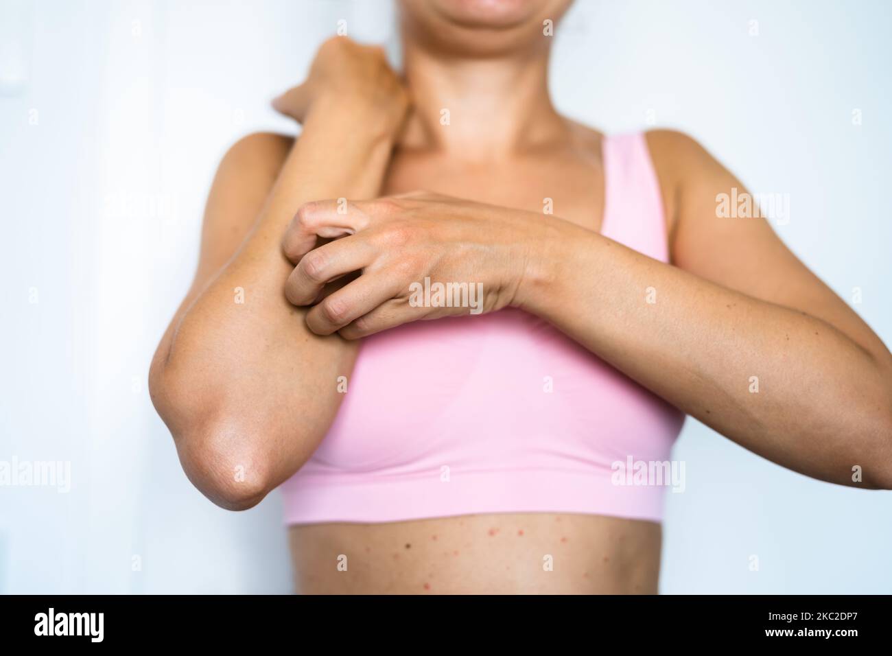 Kratzende Juckende Haut. Empfindlicher Ekzemausschlag Und Dermatitis Stockfoto