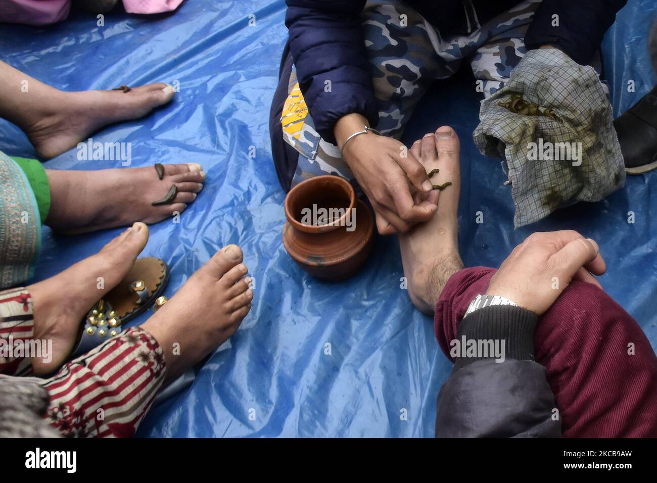 Die Menschen in Kashmiri nehmen am Vorabend des Nauroz (persisches Neujahr) in Srinagar, dem indischen Kaschmir, am 21. März 2021 eine lech-Therapie in Kashmir ein, die lokal als „Derkhe Illaaj“ bekannt ist, ist eine der ältesten komplementären Therapien, die von Kashmir zur Behandlung verschiedener Krankheiten wie Hautkrankheiten, Arthritis, chronischen Kopfschmerzen, Erfrierungen und Sinusitis. (Foto von Muzamil Mattoo/NurPhoto) Stockfoto
