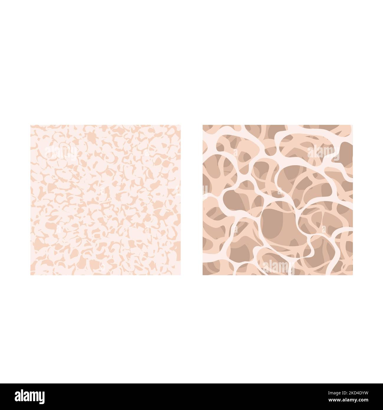 Osteoporose, konzeptuelle Illustration Stockfoto