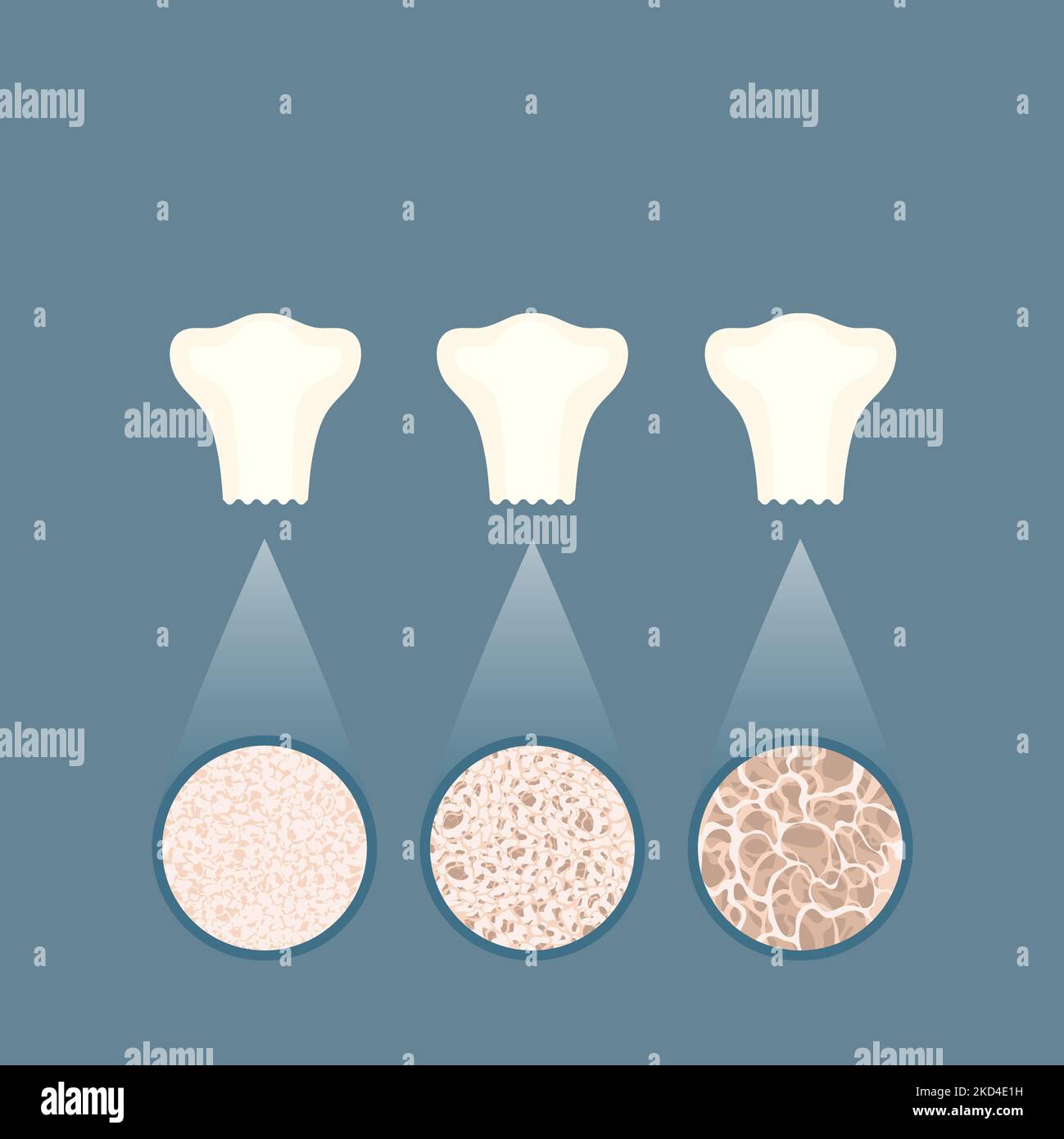 Osteoporose, konzeptuelle Illustration Stockfoto