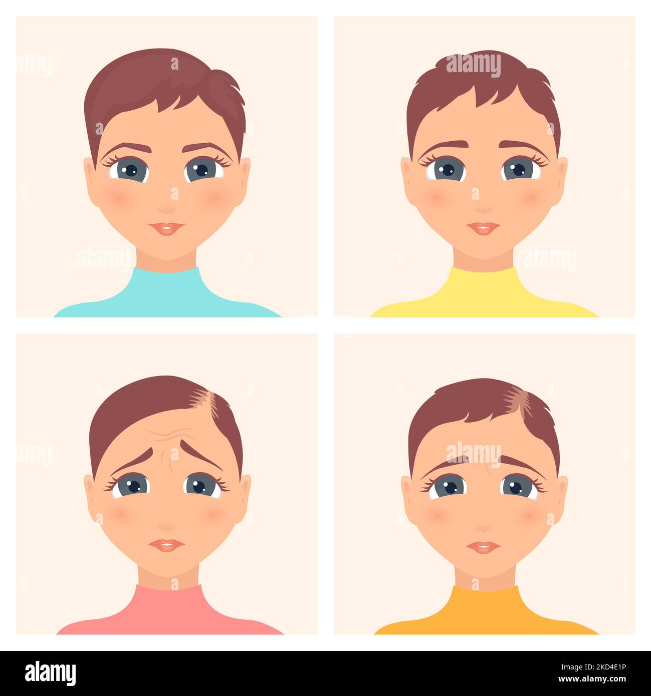 Weibliche Alopezie Stadien, Illustration Stockfoto