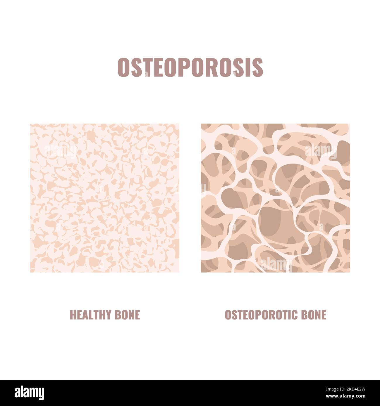 Osteoporose, konzeptuelle Illustration Stockfoto