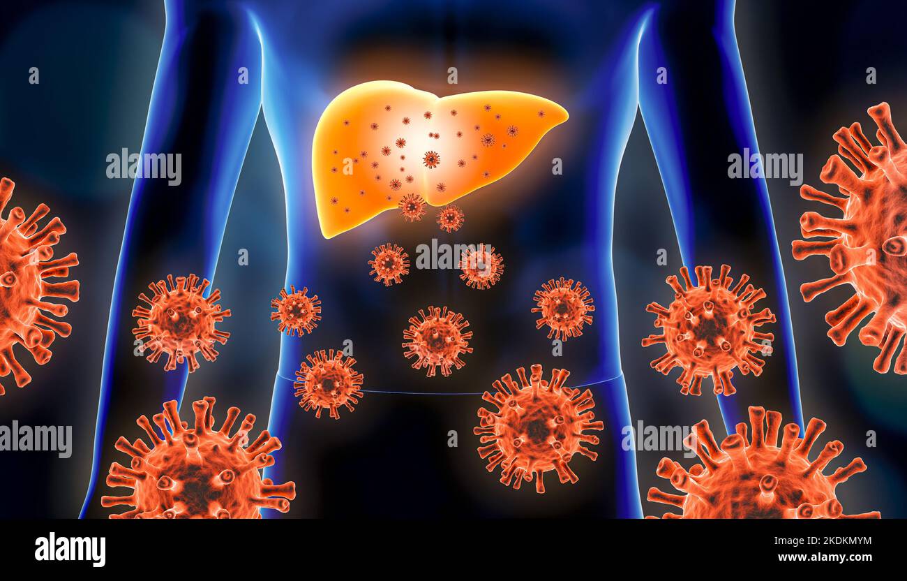 Hepatitis 3D Darstellung mit roten Viruszellen und menschlichem Körper. Virale, infektiöse und entzündliche Leber- oder Lebererkrankungen, medizinisch und heilen Stockfoto