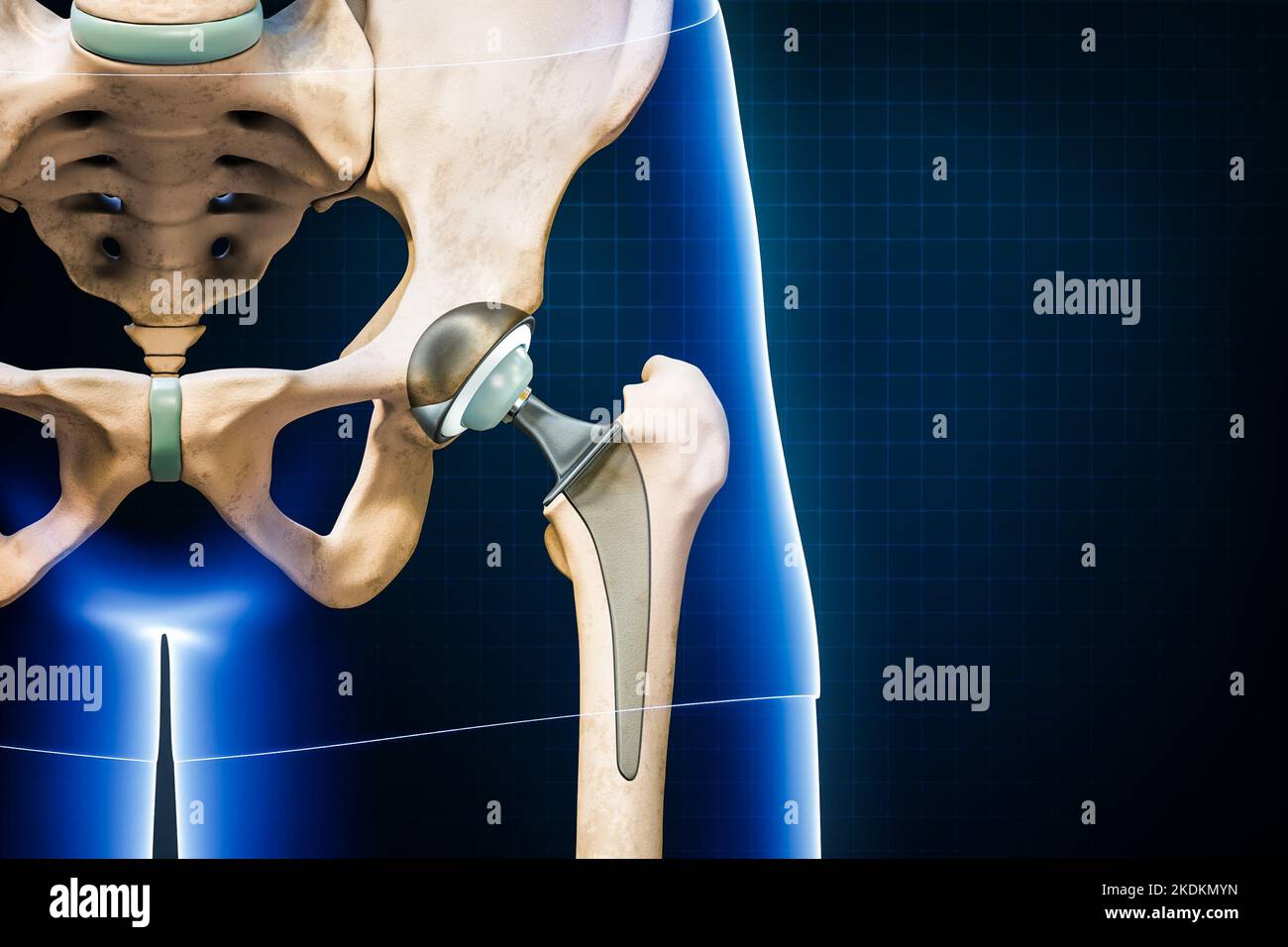 Hüftprothese oder Implantat isoliert auf blauem Hintergrund mit Kopierraum. Hüftgelenk- oder Femurkopfersatz 3D Rendering Illustration. Medizin, medi Stockfoto