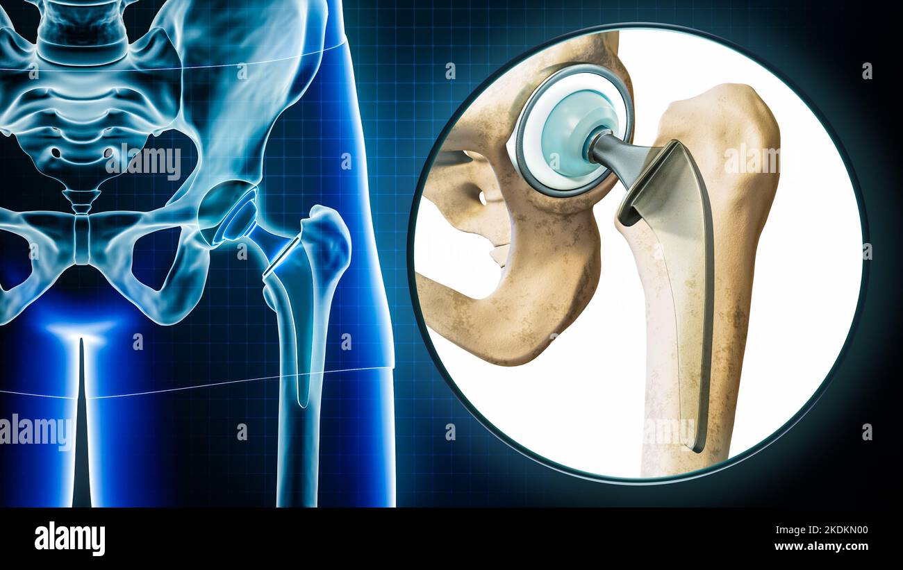 Hüftprothese oder Implantat-Röntgen mit Vergrößerung oder Nahaufnahme. Total Hip Joint Replacement Chirurgie oder Arthroplastik 3D Rendering illustraa Stockfoto