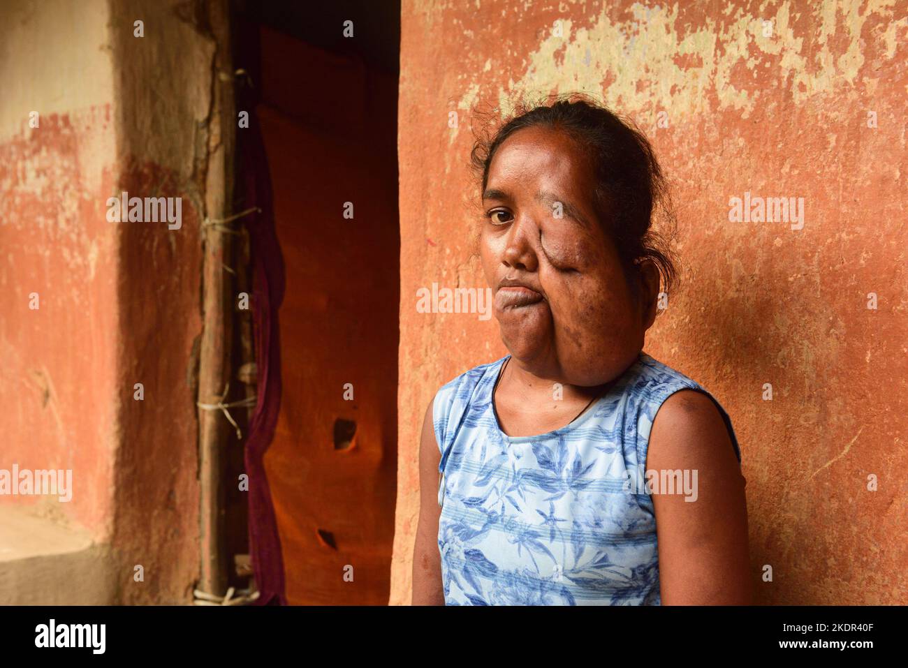 Anamika Oraon im Alter von 18 Jahren aus Dungridih in Bango von Jadugoda leidet an einem bösartigen Wachstum im Gesicht, das von Tag zu Tag wächst, aber die Operation ist teuer und riskant. Die Einheimischen und die NGOs sagen, dass die Krankheiten und Behinderungen auf die Strahlung des Uranbergbaus in den Gebieten zurückzuführen sind, sie erwähnten auch, dass Frauen Fehlgeburten haben, Lungenkrebs und Magenbeschwerden, die in den Gebieten in der Nähe des Uranbergbaus und der Versickerung aus den Tailing-Teichen in den Gebieten häufig vorkommen. Obwohl die UCIL (Uranium Corporation of India Limited) alle Anschuldigungen und entsprechende Aussagen verneint Stockfoto