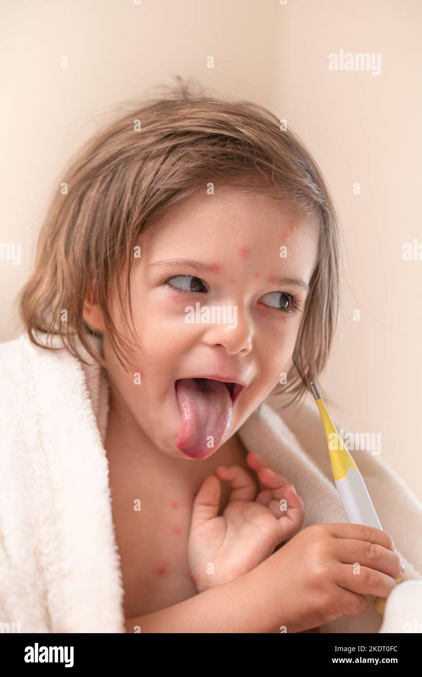 Lustiges Mädchen mit Windpocken Grimace Zunge-out mit Thermometer Stockfoto