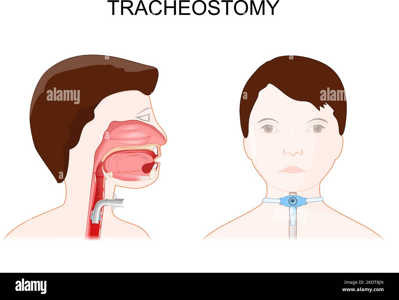 Tracheotomie. Seitenansicht des Halses und Platzierung eines Tracheostomieschlauchs in der Trachea. Außenansicht eines Patienten mit Tracheostomie in der Luftröhre. Stock Vektor