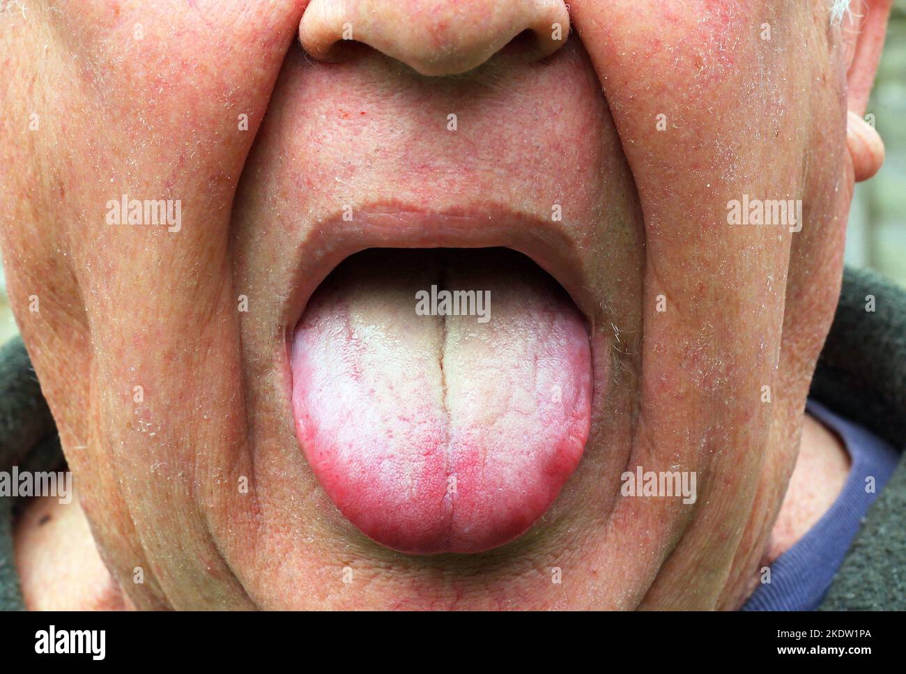 Beschichtete weiße Zunge. Möglicherweise durch Soor oder Bakterien. Mundinfektion. Candida-Pilz. Stockfoto