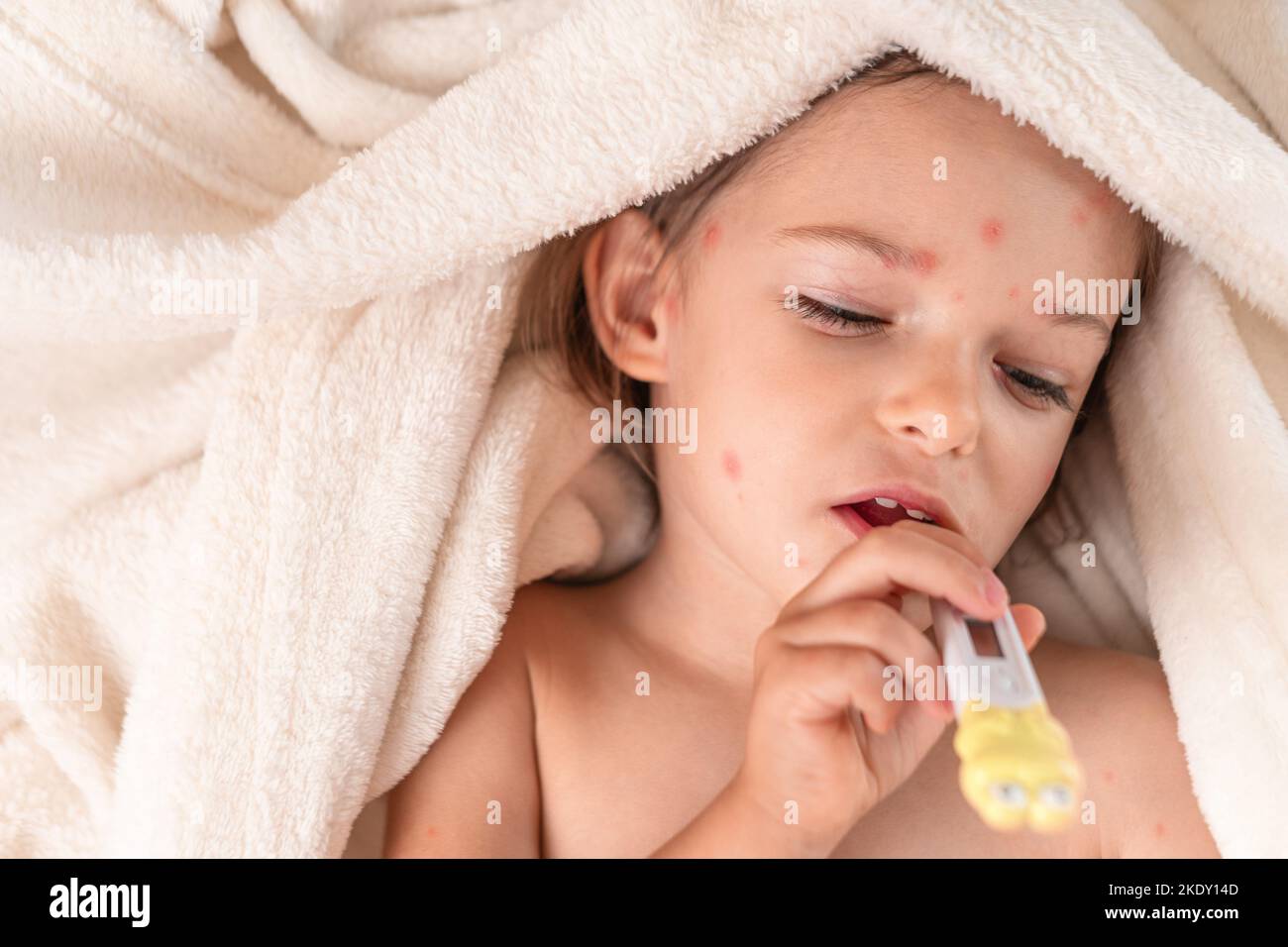 Kind mit Windpocken im Bett liegend mit Thermometer Stockfoto
