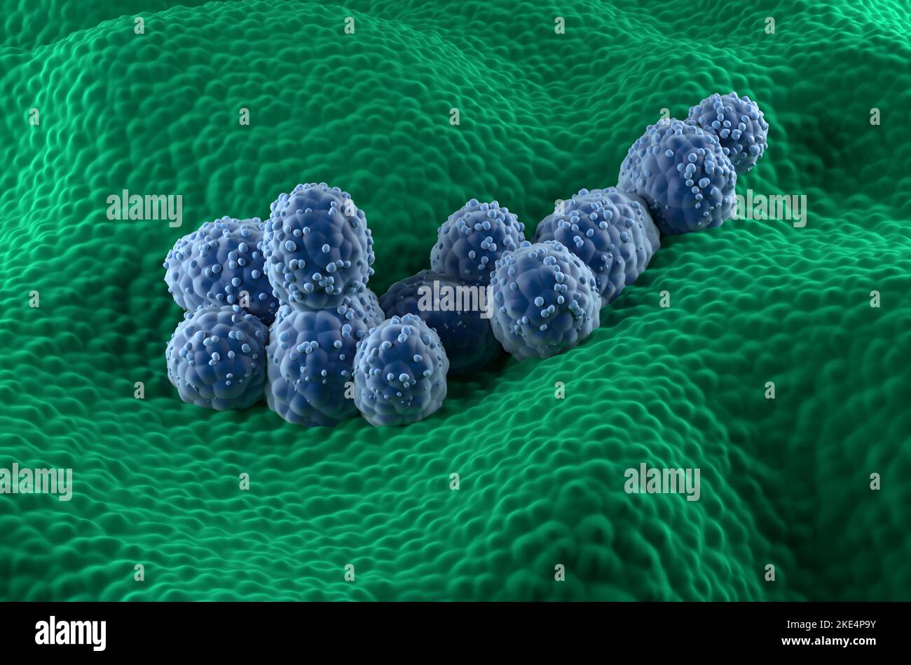 Prostatakrebszellen im prostatischen Drüsenepithel - isometrische Ansicht 3D Abbildung Stockfoto